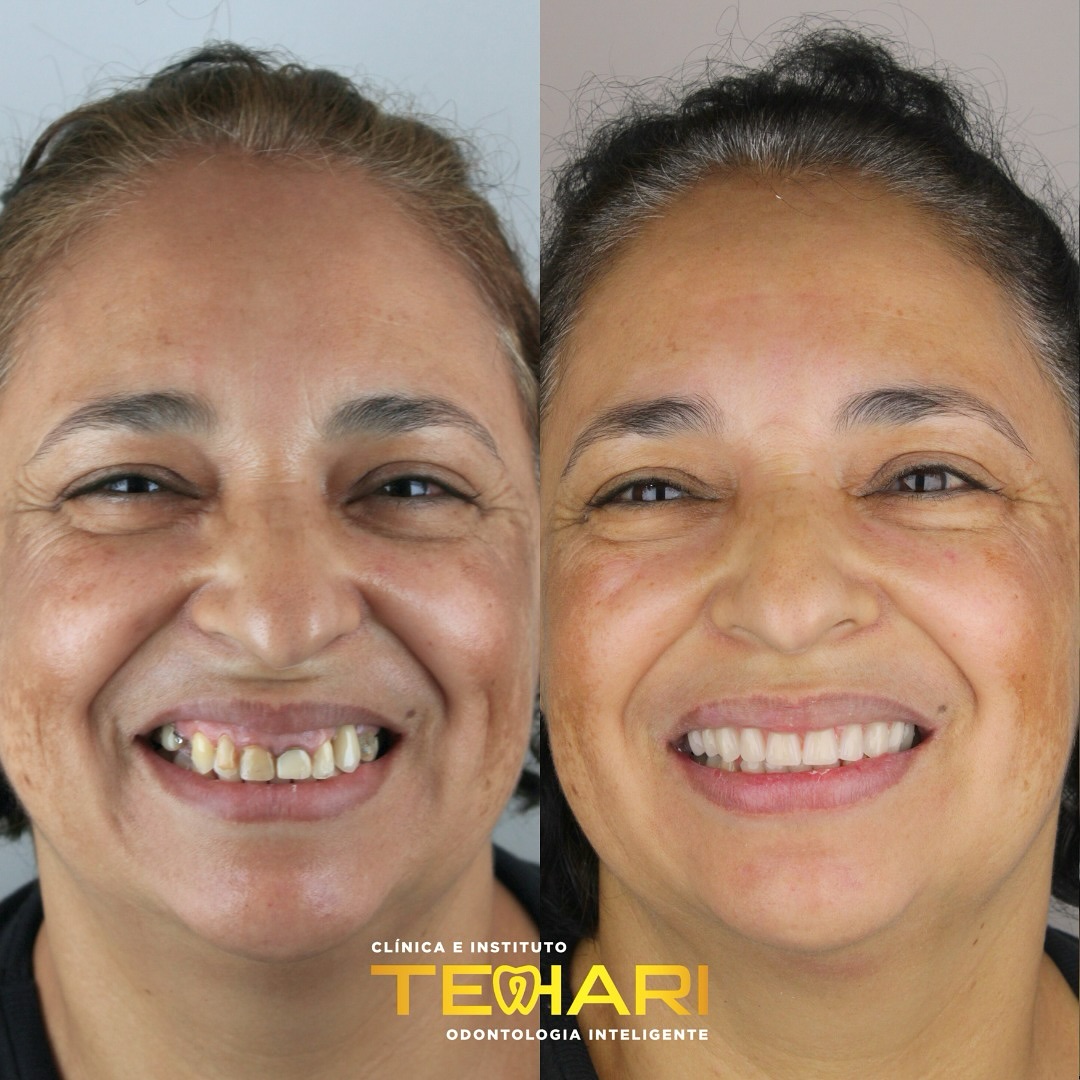Transformação incrível! Antes e depois da prótese de protocolo. Sorriso renovado e mais qualida