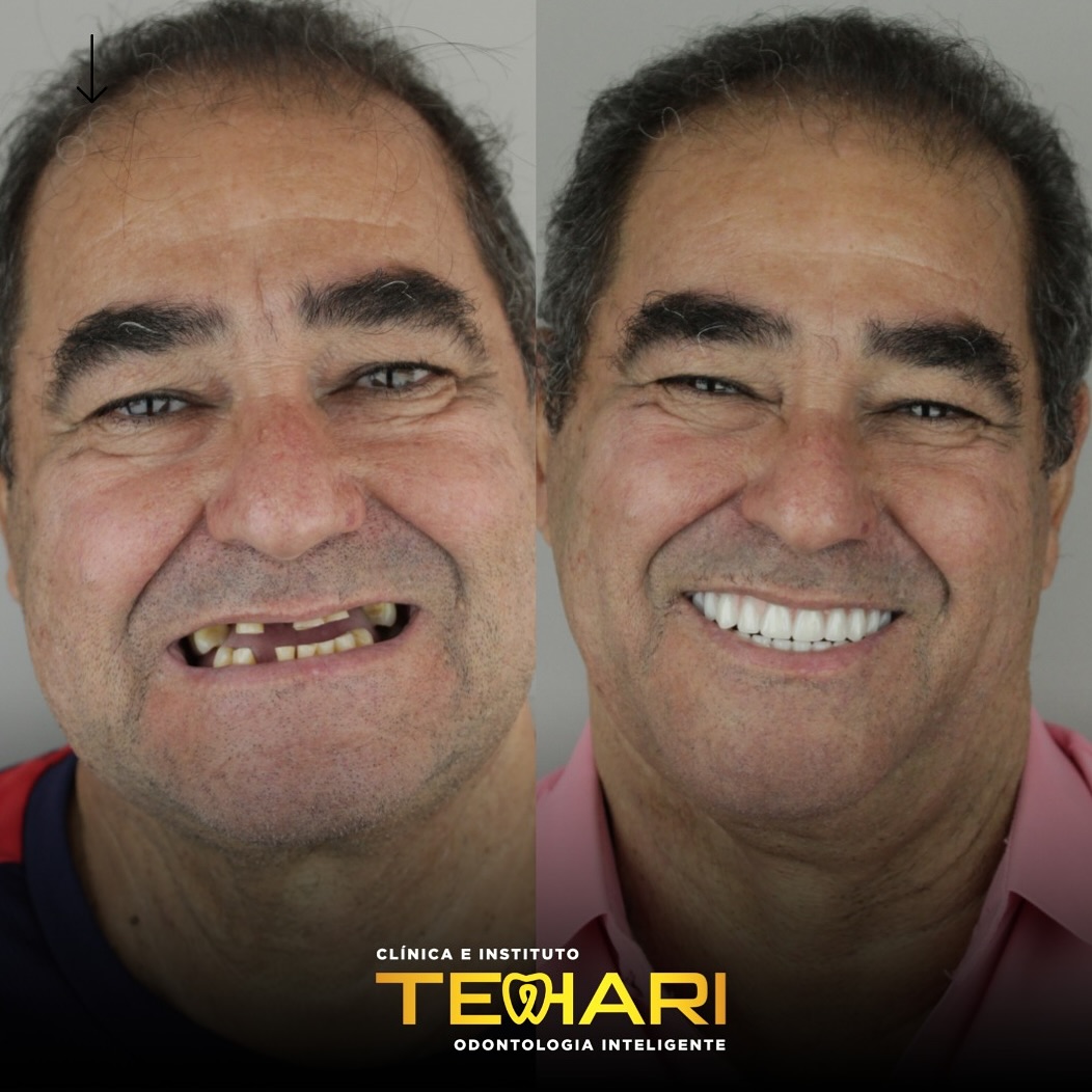 ✨ Sorriso novo, vida nova! ✨Olha só essa transformação com protocolo fixo- o antes e depois fala